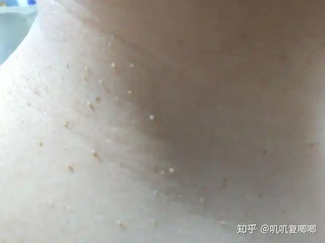 丝状疣,脖子上,女性,医生说要激光扫,有别的办法吗? - 知乎