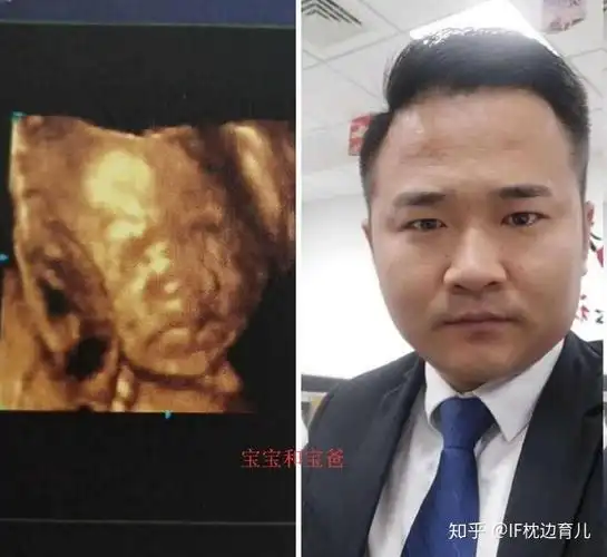 四维彩超宝宝鼻子大,知道四个原因,孕妈可以安心了