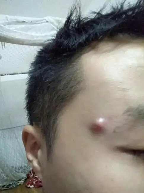 脸上长这颗痘包怎么办