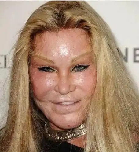 明星们网红们整容后是很漂亮 但是谁会知道她们也会受到 后遗症的