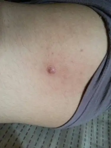 大腿上长了个疙瘩,摸起来软软的,有点疼,好像里面有水,是什么?