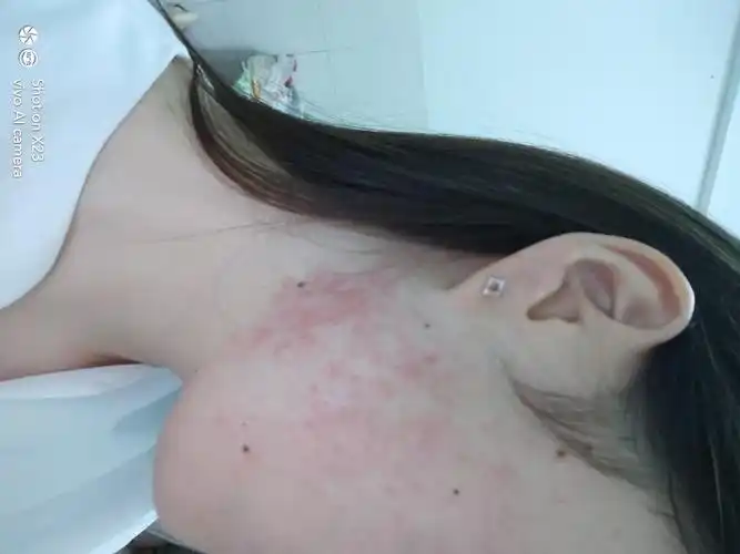 擦红霉素过敏了,然后擦丹皮酚也没有用,昨天擦了点芦荟更严重了,现在