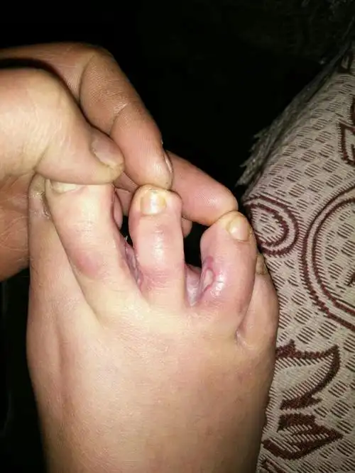 前二个月去医院看了说是烂脚丫但是狠多药都试过了没效果现在要怎么