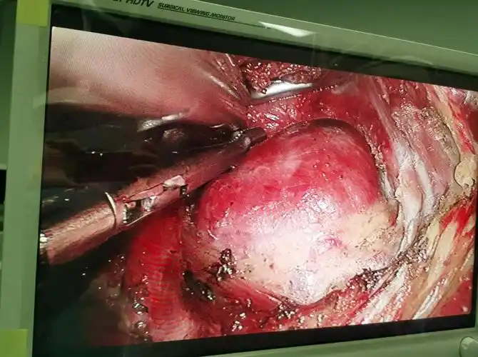 该手术在腋窝自然皱襞一4cm小切口下完成