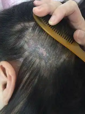 系统性红斑狼疮五年了每次复查各项指标都正常但是头部局部掉发厉