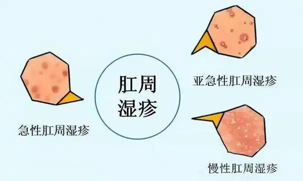 发病与内外多种因素有关手部湿疹的常见症状包括皮肤损伤和皮肤瘙痒