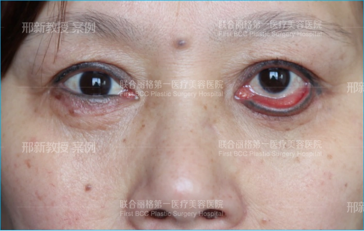 下睑手术晚期并发症的处理方法latecomplica