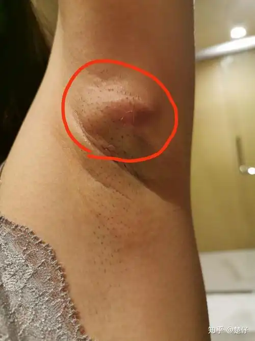 一个火疖子能大到什么地步? - 知乎