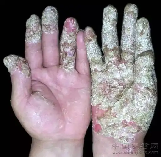 288.指背部连续性肢端皮炎