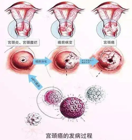 女性朋友如何预防宫颈癌