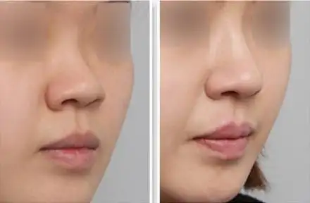 玻尿酸隆鼻对比照片