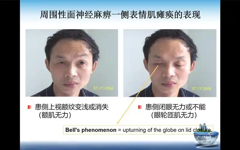 【周围神经病系列1】面瘫/面神经炎/周围性面神经麻痹
