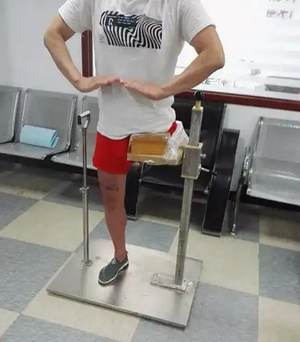 人工造瘘术后髋离断假肢患者安装假肢后站立行走