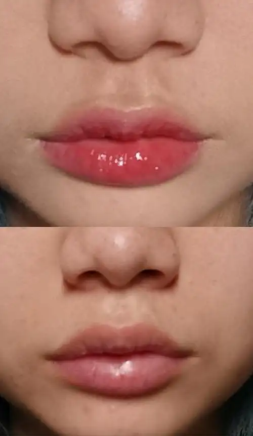 弱化凸嘴(正面视觉将凸嘴改造成嘟嘟唇)