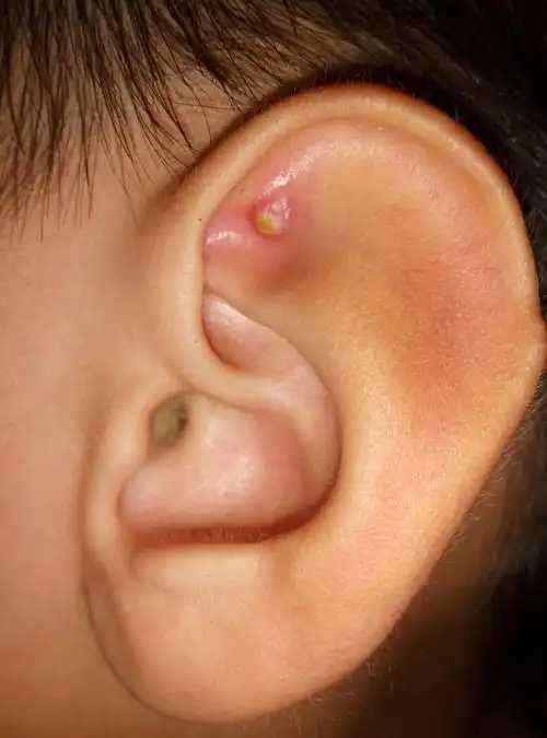 去医院问了下,医生说是个假性囊肿,如果不长就不用管,如果长就手术