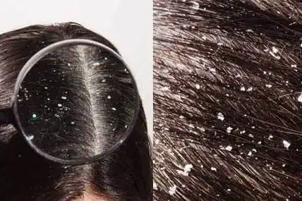 头皮干燥头屑多怎么办 养成良好的生活习惯可缓解