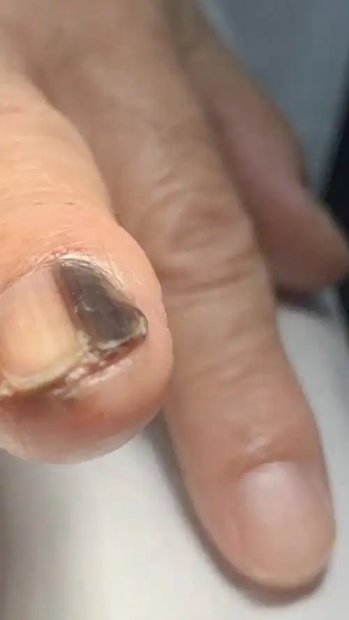 指甲出现黑线可能是恶性肿瘤?