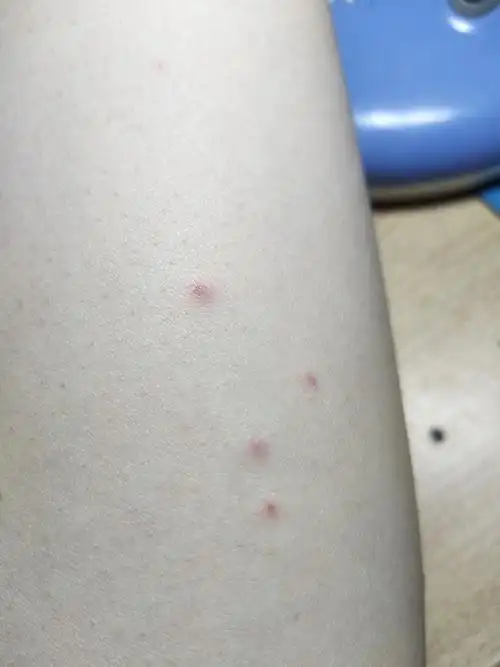 皮疹  追问 会自己消失吧,就长了五六个点,没必要去皮肤科吧 追答 有