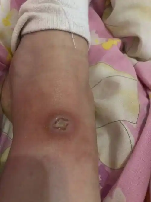 是否出现内部化脓的症状,是否出现了组织坏死等2对于伤口化脓情况比较