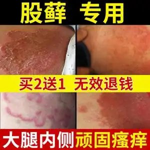 体股藓大腿内侧瘙痒真菌感染癬股癣屁股牛皮癣止痒专用股癣药膏