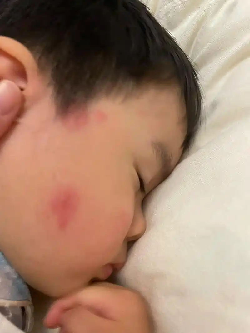 过敏体质宝宝 儿子时不时脸上会有红疙瘩,还有身上痒抓后皮肤 - 兑趑
