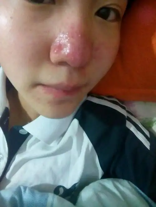 【病因分析】玫瑰痤疮(酒糟鼻)病因有哪些 - 酒糟鼻 - 南京华肤皮肤病