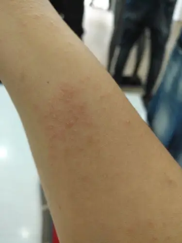 过敏性湿疹怎么治疗很痒 求帮忙