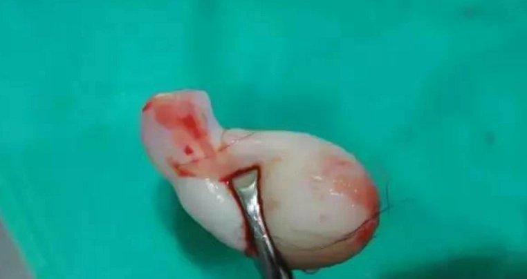 产妇顺产一个月后,突然蹦出"一块肉",医生怒斥丈夫"无知"!