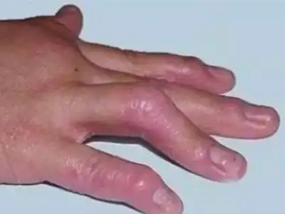 风湿性关节炎手指关节发红肿胀图.png