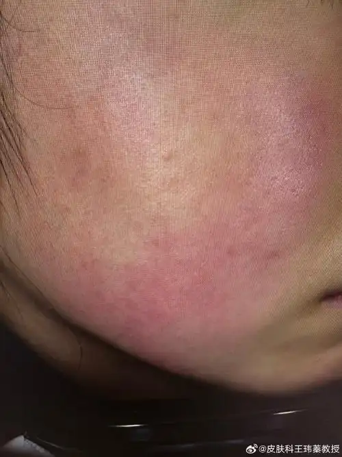 导致面部皮肤发红的原因很多,主要包括:敏感性皮肤,玫瑰痤疮,接触性