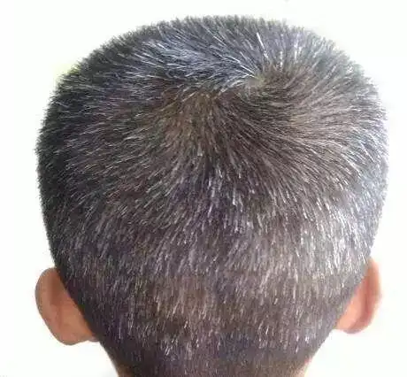 年纪轻轻却长出了白发,全都是因为这些原因!