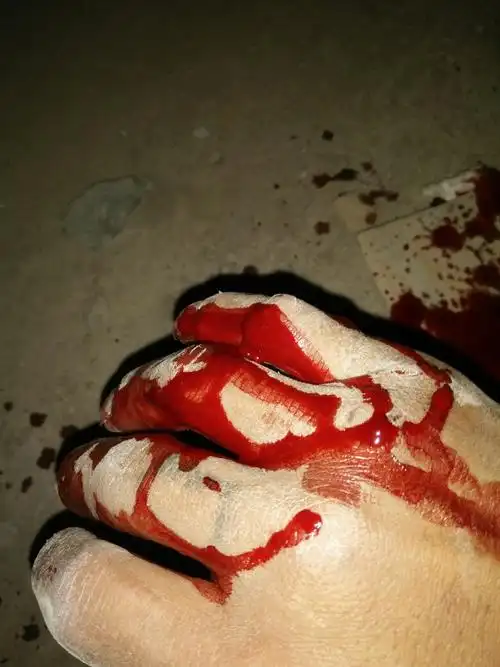 我手昨天在工地上受伤,缝了7针.