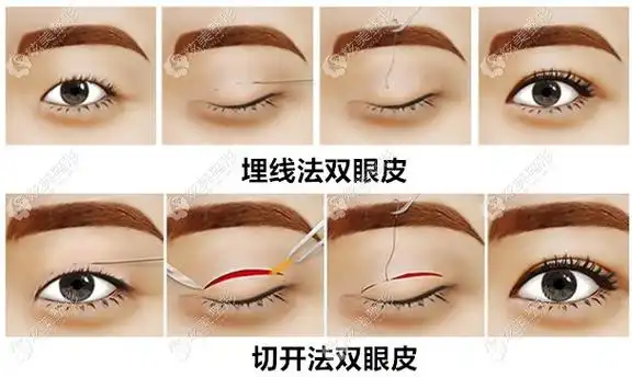 me双眼皮和埋线有啥区别?me双眼皮和全切哪个好