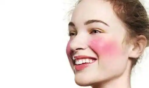 激光去红血丝告别尴尬症红脸蛋儿