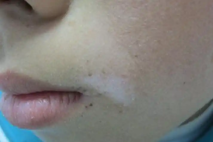 孩子嘴角有块白斑图片