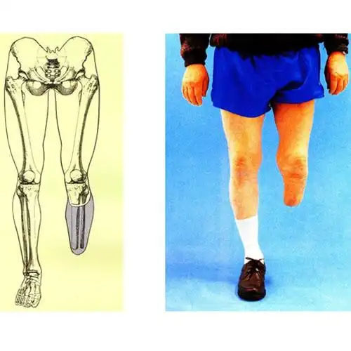 大腿及膝关节离断假肢