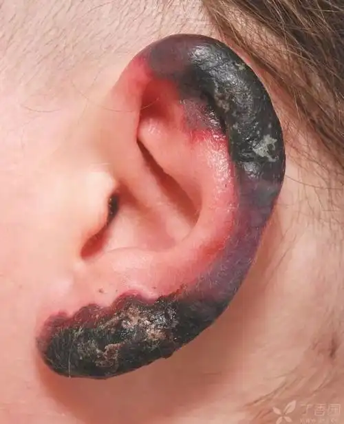 焦黑的耳朵!