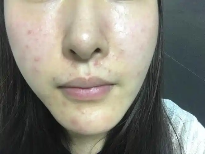 流产之后脸上皮肤开始粗糙油腻一开始是闭合型粉刺现在变成