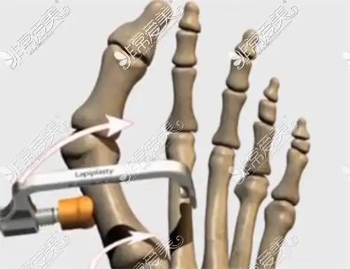 既然是一跖骨偏斜导致了大脚骨,那就需要通过截骨等方式将一跖骨掰直