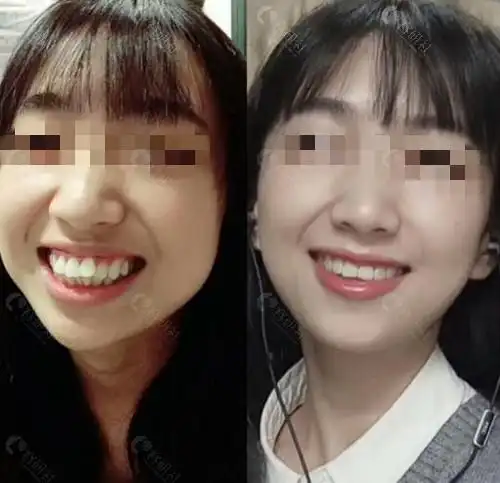 郑州互齿家口腔牙齿矫正前后对比图