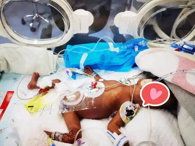 怀孕6个半月产下巴掌男婴!680克的生命,勇闯层层难关!