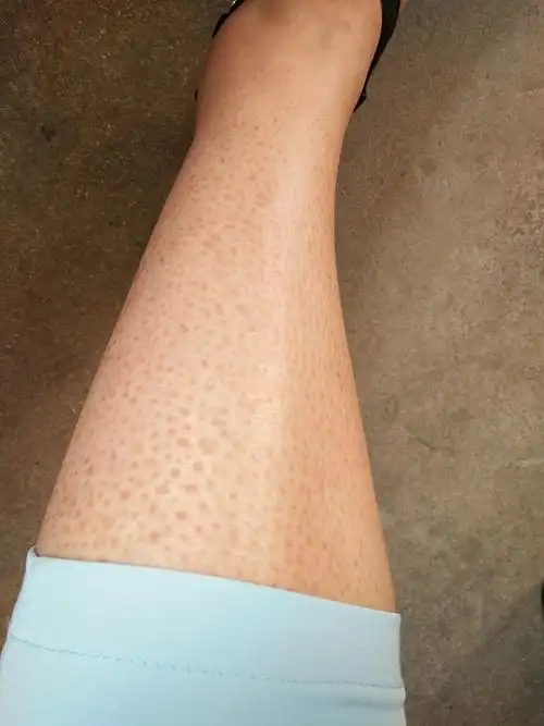 干性皮肤腿上有蛇皮怎么消除?