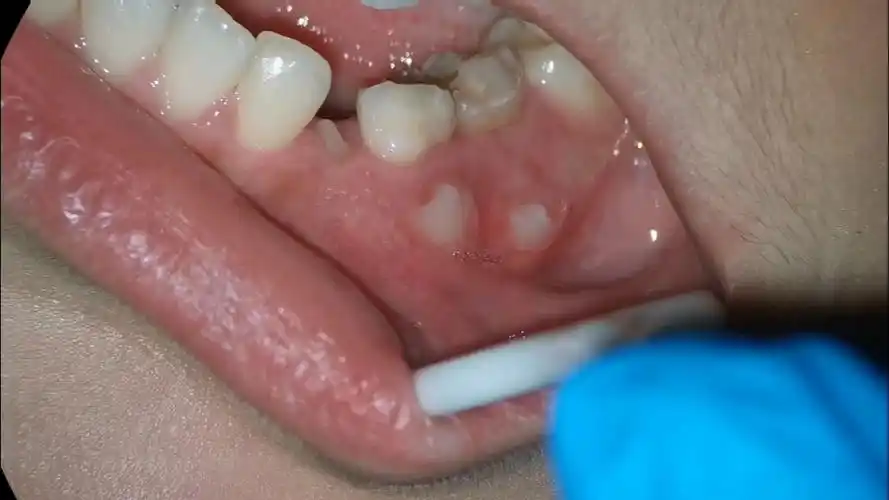 九岁小帅哥的恒牙从牙龈的外面长出来了