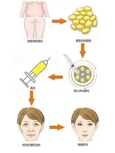 自体脂肪填充后脂肪会移动吗?