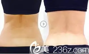 邯郸雅丽腰腹部吸脂前后对比