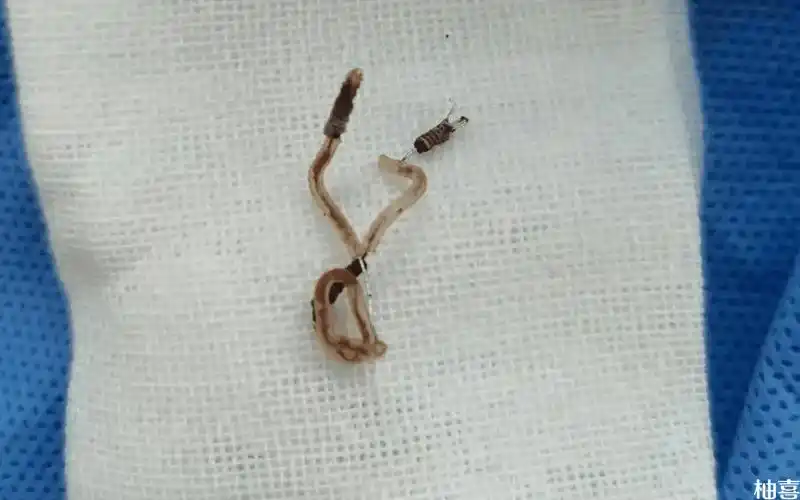 吉妮环怎么取讲究多,牢记注意事项方能更好取出