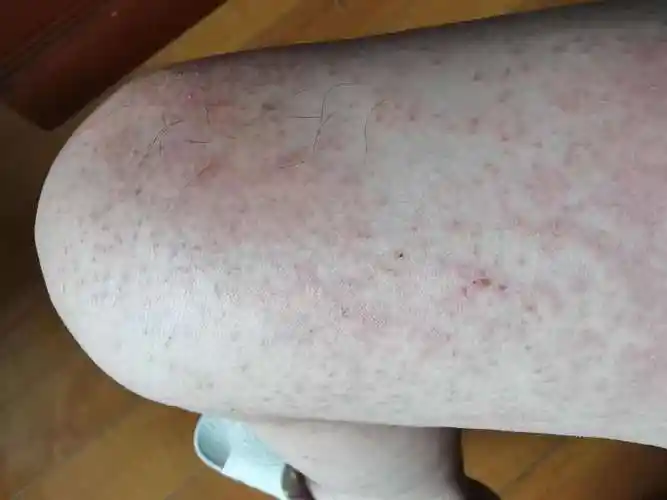 大腿上起红疹多半是过敏导致的来看解决办法