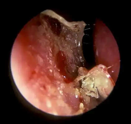 鼻窦炎症状图片 (44)