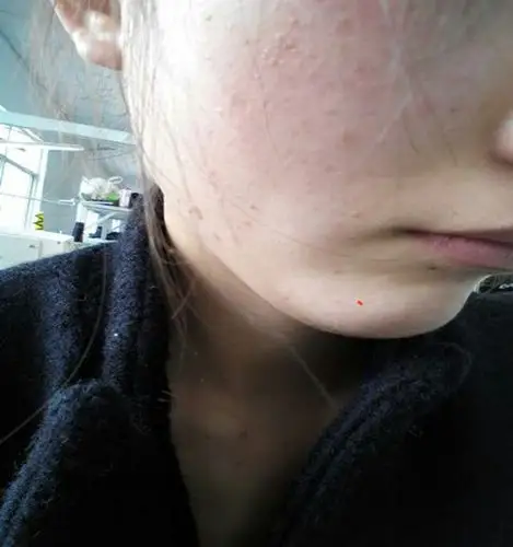 扁平疣初期症状