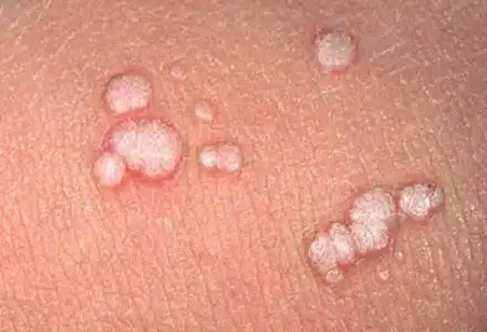 尖锐湿疣图片_尖锐湿疣症状表现图片大全_有来医生